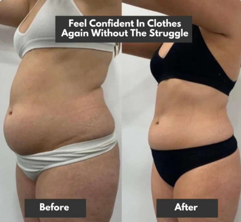 Before and after comparison of a woman’s midsection showing body transformation using the BodiBeam™ Belt