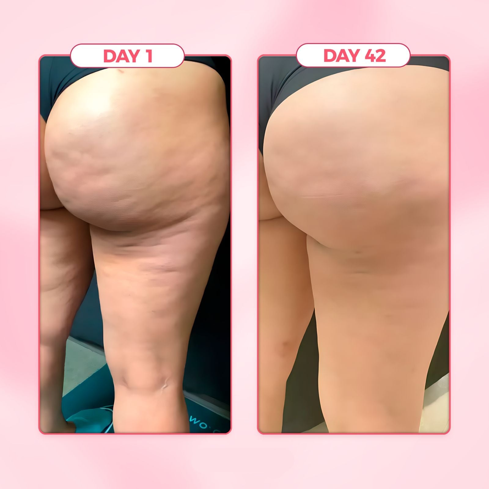 VitaSculpt™ Cellulite Relief Kit before and after results on day 1 and day 42.