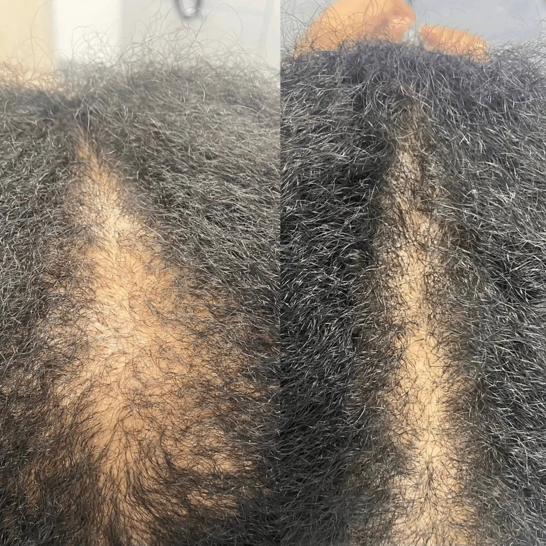 Before and after close-up of scalp showing hair regrowth from using Revellia Hair Therapy